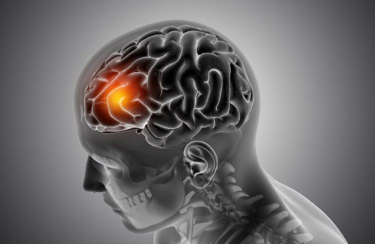 O acidente vascular cerebral  a segunda causa de morte e a primeira causa de incapacidade no mundo