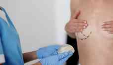 Reconstruo mamria melhora autoestima aps retirada de tumor