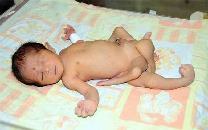 Depois de pouco mais de uma semana de tratamento os mdicos operaram a criana(foto: AFP PHOTO/NATIONAL INSTITUTE OF CHILD HEALTH )