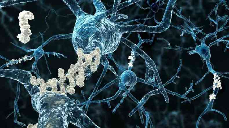 Placas amilides mostradas em axnios de neurnios afetados pela doena de Alzheimer