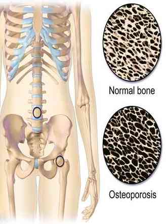 osteoporose atinge cerca de 10 milhes de pessoas no Brasil(foto: Reproduo )