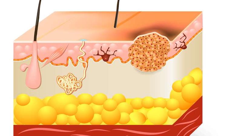 ilustração de um carcinoma basocelular
