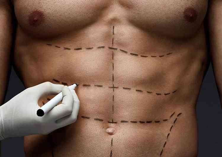 Cirurgia  indicada para pacientes com excesso de pele aps perda excessiva de peso