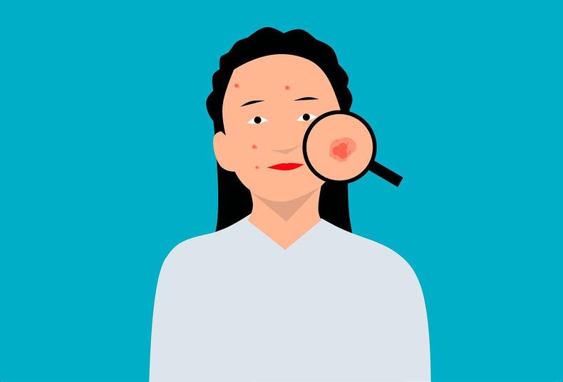 (foto: Pixabay) Ilustração mostra jovem com lente de aumento sobre o rosto, onde se vê ponto vermelho de acne