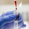 Biópsia líquida: exame de sangue permite acompanhar evolução do câncer