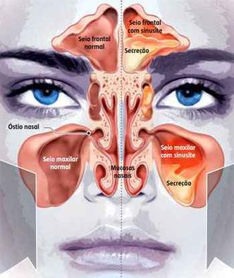 Resultado de imagem para sinusite fotos reais