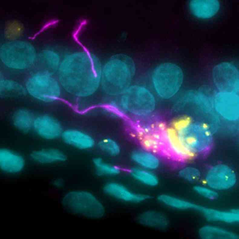 Imunoflorescncia mostra Sars-Cov-2 (amarelo) afetando um neurnio (rosa)(foto: Jonas Franz/Universittsmedizin Gttingen)
