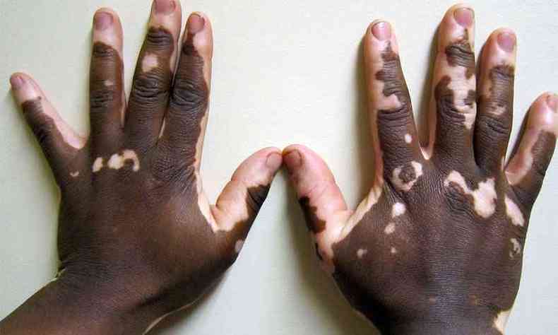 Vitiligo provoca a perda da pigmentao da pele(foto: James Heilman,MD)