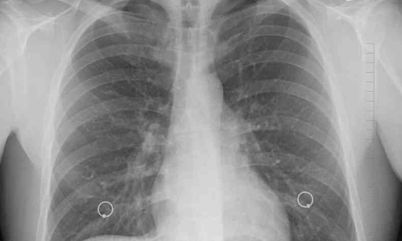 raio x dos pulmões