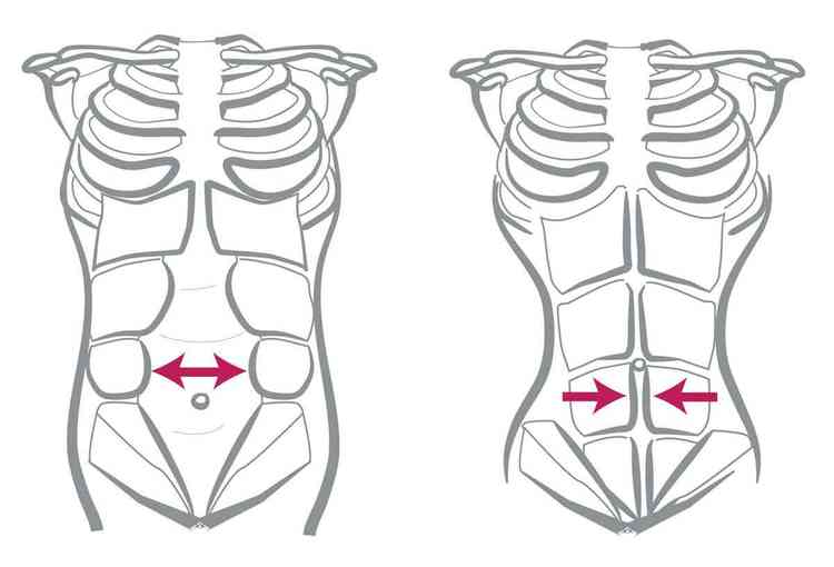 imagem sobre Distase abdominal