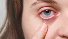 Entenda como surge o herpes ocular