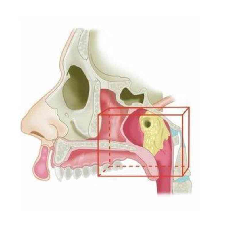 As possveis novas glndulas foram encontradas no topo da garganta(foto: VALSTAR, ET. AL./RADIOTHERAPY AND ONCOLOGY)