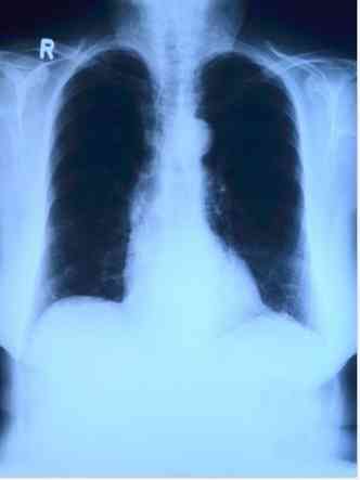 Cuidados para evitar a embolia pulmonar est relacionada na preveno da trombose venosa profunda(foto: Reproduo da internet)