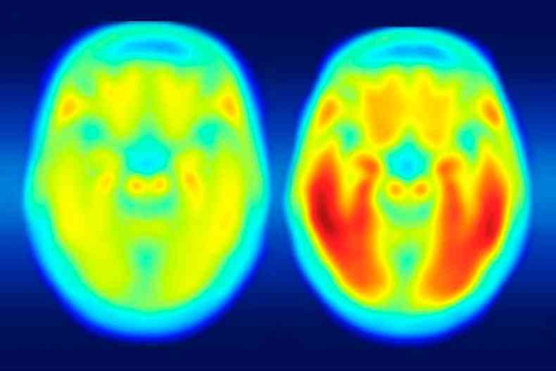 Ressonncia magntica busca sinais precoces do Alzheimer(foto: Matthew R. Brier/Divulgao)