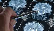 Medicamento experimental contra Alzheimer tem resultados 'históricos'