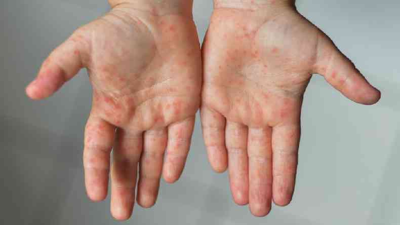 Mãos com sarampo