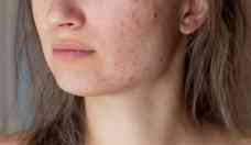 Acne: usar colrio para suavizar espinhas pode dar alergia e irritar a pele
