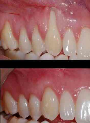 Antes e depois de uma pessoa que realizou o tratamento da recesso gengival, na foto de cima o dente est muito exposto 