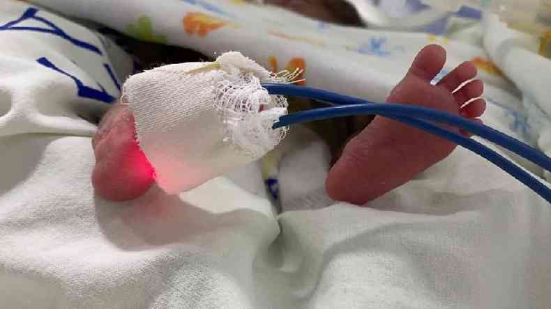 Filhas de Expedito nasceram com 26 semanas, mas se recuperam bem na UTI neonatal(foto: iSEA)