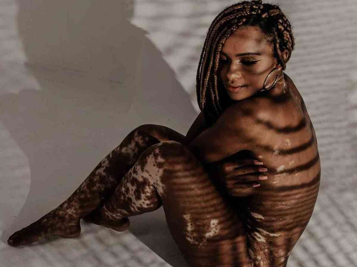 Vitiligo: entenda a doença de Natália Deodato, participante do BBB22 -  Saúde - Estado de Minas