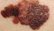 Câncer de pele: como identificar pintas, manchas e outros sinais 