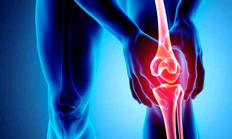 Ilustrao mostra ossos do joelho afetados por artrite 