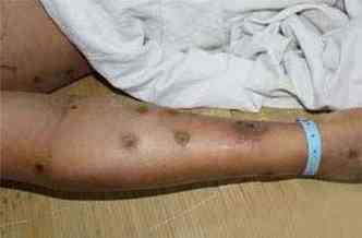 O veneno dos ferres provocam feridas (foto: Reproduo Internet /www.dmnewsi.com)