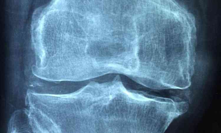 raio-x de um joelho humano