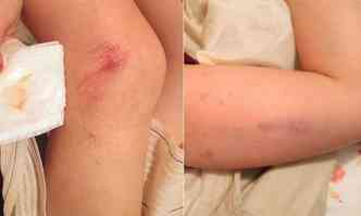 As imagens mostram hematomas e machucados nos braos e em uma das pernas da mulher(foto: Divulgao)