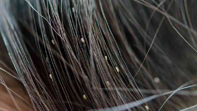 Foto colorida mostra close em pontinhos brancos ovalares presos em fios de cabelo preto