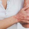 Dermatite atópica: dermatologistas alertam pais sobre a doença