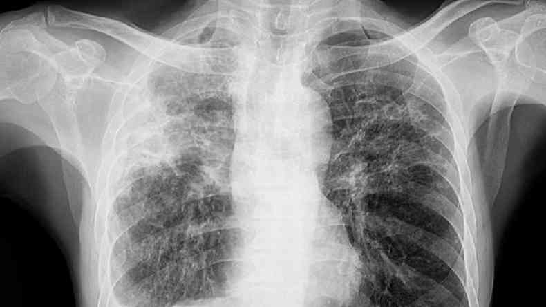 Raio-x de pulmo de paciente com tuberculose