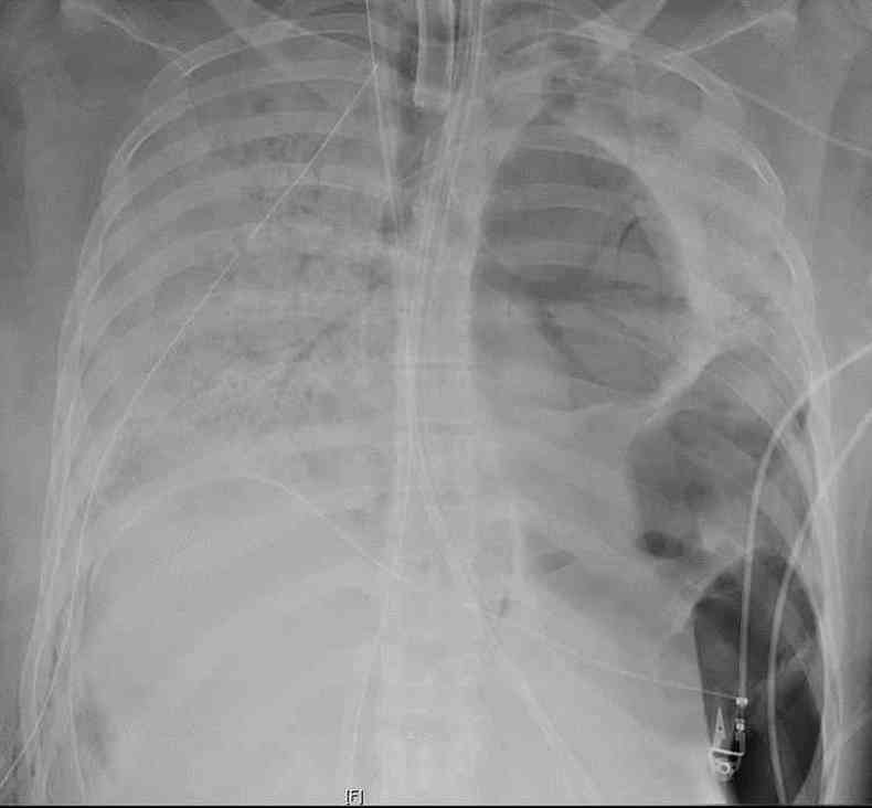 Raio-X mostra que os pulmes da paciente apresentavam danos irreversveis(foto: Northwestern Medicine)