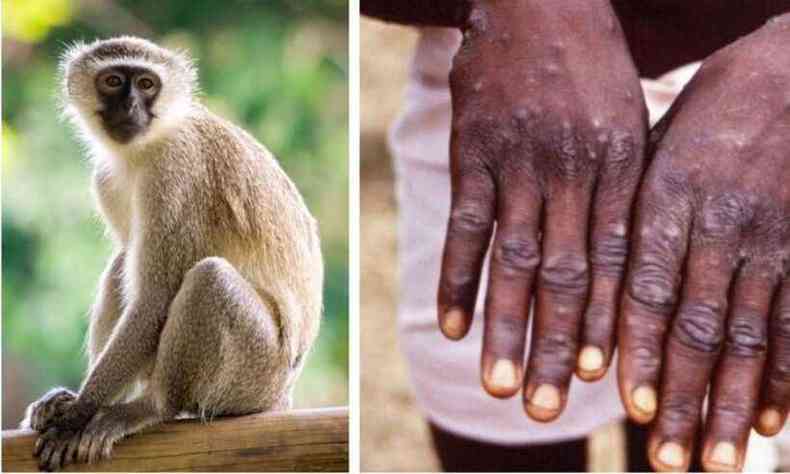 Montagem de fotos:  esquerda um macaco;  direita, mos de uma pessoa negra com marcas da varola