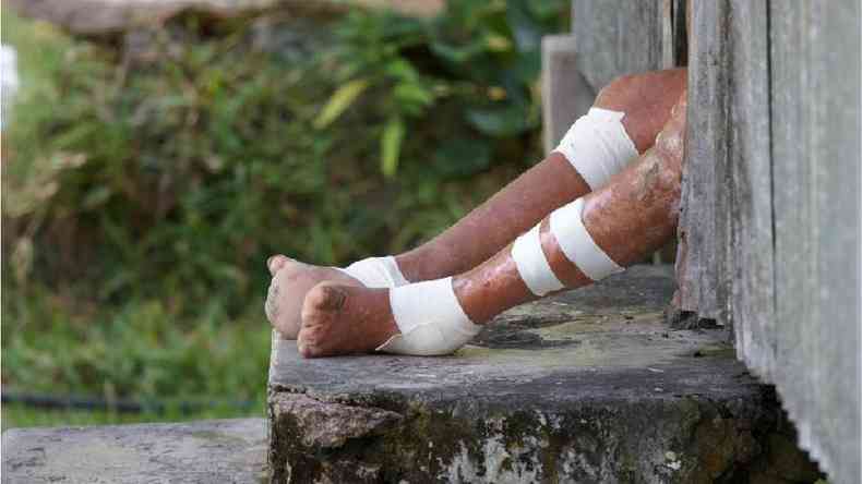 A hansenase  uma das doenas que podem debilitar as pessoas afetadas para o resto da vida(foto: Getty Images)