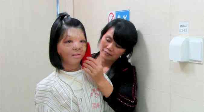  Xu Jianmei passou por uma cirurgia de reconstruo facial(foto: REUTERS/China Daily)