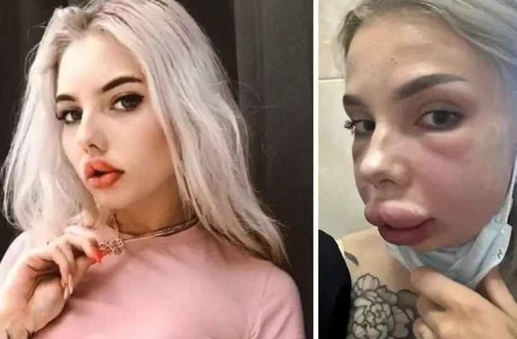 Influencer com inchaço na boca