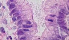 H. pylori: bactria causa mais de 60% dos casos de cncer de estmago 