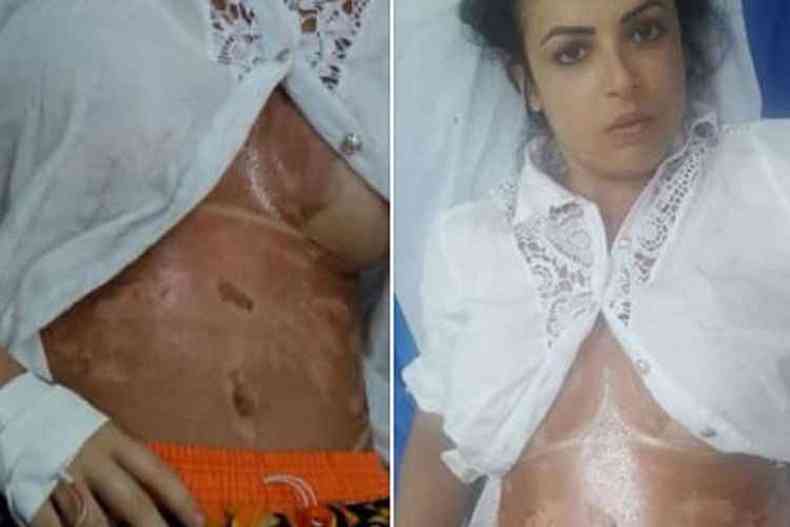A modelo Aline Borges, de 28 anos, acusou a esteticista Joice Radaelli de ter causado queimaduras (foto: Arquivo Pessoal )
