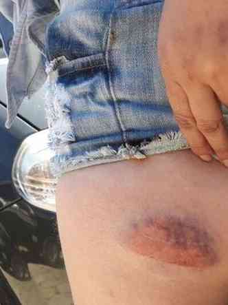 Jovem de 25 anos exibe leso que teria ocorrido durante sua priso(foto: Arquivo Pessoal)