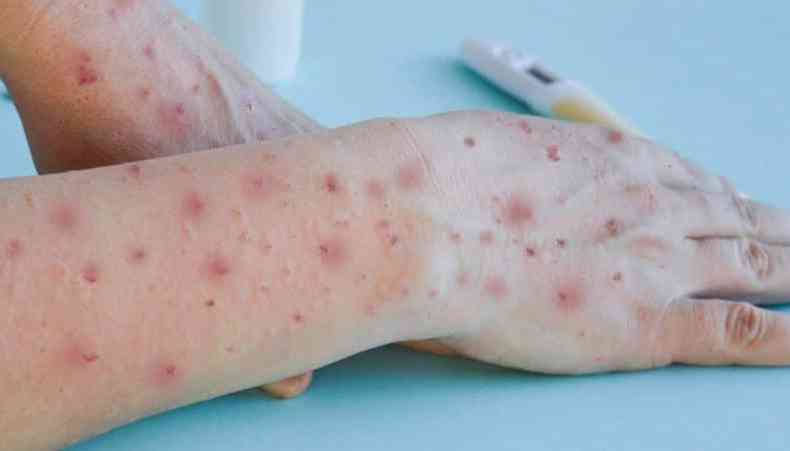 Braço com manchas relacionadas à infecção pela varíola dos macacos