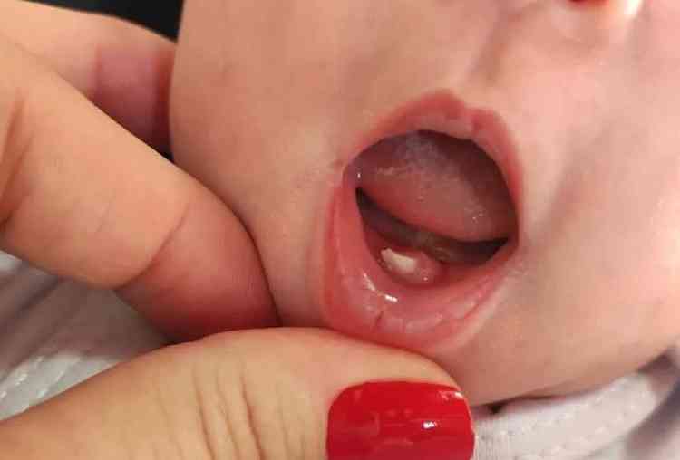 Fenômeno, conhecido como dente natal, ocorre, aproximadamente, em um bebê a cada três mil partos
