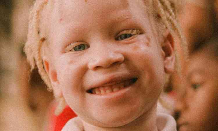 menino albino sorrindo
