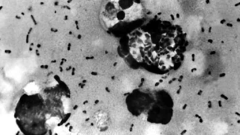 Uma amostra de peste bubnica em tecido removido do gnglio de um paciente(foto: Getty Images)