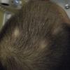 Como fazer o cabelo crescer? Veja tratamentos disponíveis no mercado