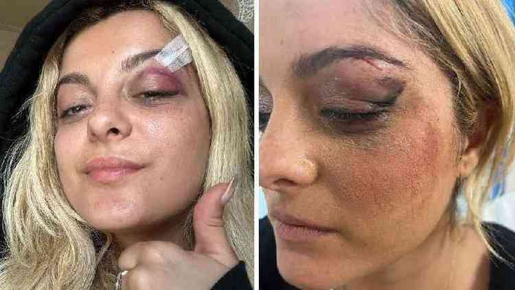 Bebe Rexha mostrou seus ferimentos em um post no Instagram