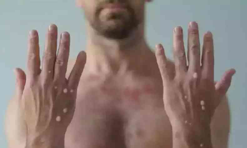 Homem sem camisa mostrando as mãos com sintomas da varíola dos macacos