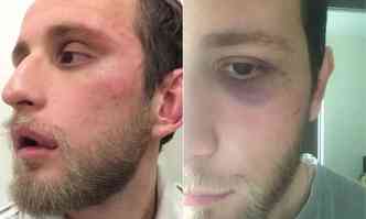 Advogado de 24 anos publicou fotos do rosto ferido aps a agresso. Ele levou pontos na boca(foto: Reproduo internet/Facebook)