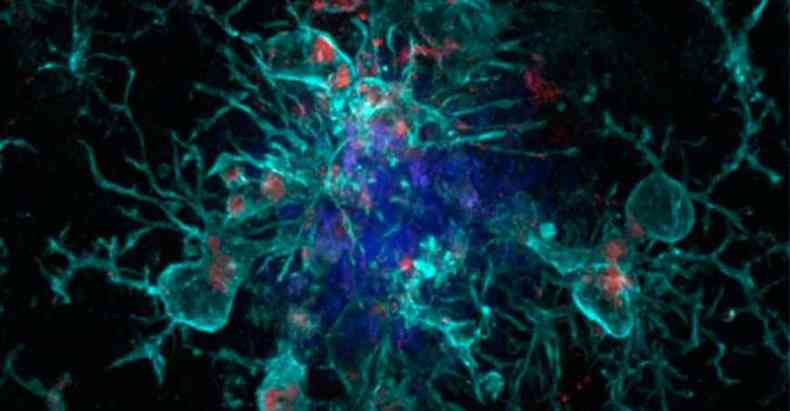 Ausncia da protena YKL-40 pode ajudar as micrglias (turquesa com pontos vermelhos) a removerem placas de amiloide (azul) do crebro(foto: Brian Lananna/Divulgao)