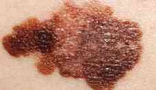 Pesquisadores da UFV desenvolvem molcula capaz de tratar cncer de pele